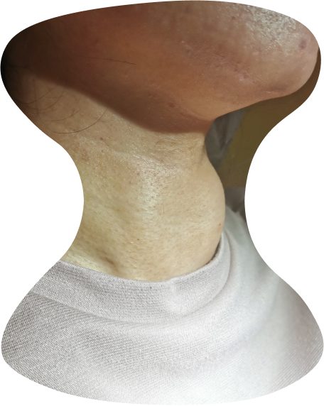 A close-up image of a patient with hyperthyroidism.