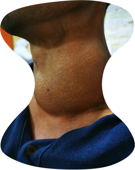 A close-up image of a patient with Goitre.